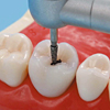 軟化象牙質の除去／A26
