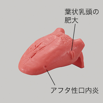 説明用舌癌模型 [P21-X.1321]