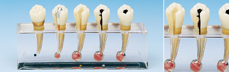 歯髄疾患処置説明用模型 [PE-END002 (P23-END.2)]