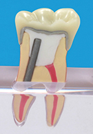 歯冠修復、根尖病巣の治癒