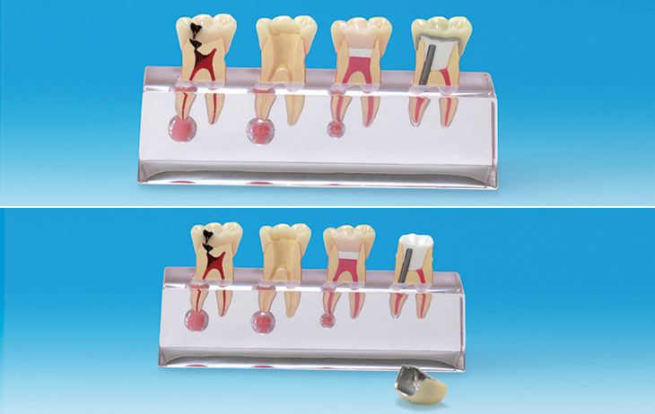 歯髄疾患処置説明用模型 [PE-END003]