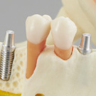 歯石除去（歯周病）