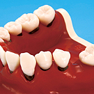 歯肉の炎症や歯肉の退縮