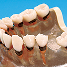 歯槽骨の吸収状態や縁下歯石
