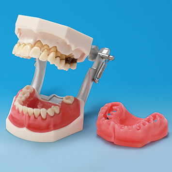 歯周病説明用顎模型 [PE-PER003(P15D-TRM.653)]