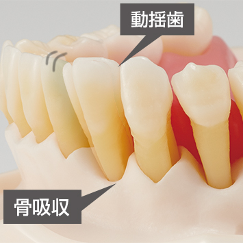 歯周病・インプラント周囲炎説明用模型 [PE-PER015]