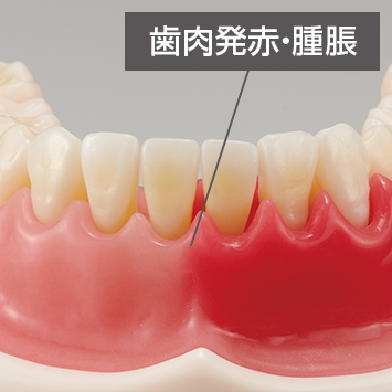 歯周病・インプラント周囲炎説明用模型 [PE-PER015]
