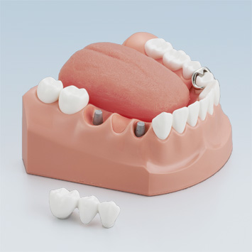 口腔ケア指導用顎模型 [PE-STP011 ]