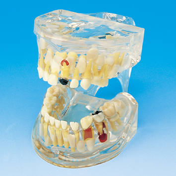 透明乳歯疾患模型 [PE-TDS002 (P12P-100R) ]