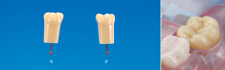 単根模型歯 永久歯 [A1AN-SW.K.10]