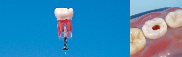 歯髄切断用乳歯模型歯 [A24AN-204]