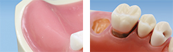 歯の欠損＆歯根リセクション