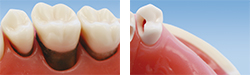 歯根リセクション＆歯の欠損