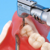 埋伏歯の抜歯