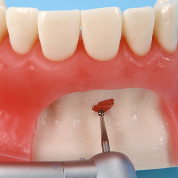 口腔外科用顎模型 [P15-OOP.1](咬合器なし)