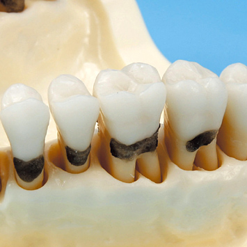 歯周外科実習用顎模型 [P15D-901C](D咬合器つき)
