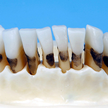 歯周外科実習用顎模型 [P15D-901C](D咬合器つき)