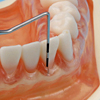 病変状態と正常状態が混合した解剖学的歯根モデル
