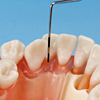 分岐部欠損など様々な病変と不正歯列を付与した解剖学的歯根モデル