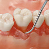 分岐部欠損など様々な病変と不正歯列を付与した解剖学的歯根モデル