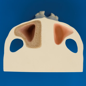 インプラント複合症例実習用顎模型 [P9-X.1121]