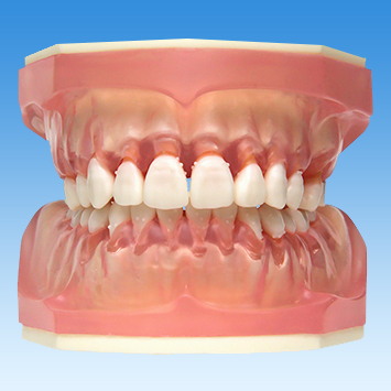 歯周病学基礎実習用顎模型(歯槽歯肉クリアピンク色・D咬合器つき) [PER1032-UL-SCP-DM-28]
