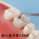 軟化象牙質の除去