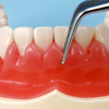 歯肉切除術