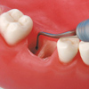 脱臼歯牙の再植固定