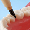 脱臼歯牙の再植固定