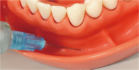 浸潤麻酔実習用顎模型 [P6FE-OOP.6](FE咬合器つき)